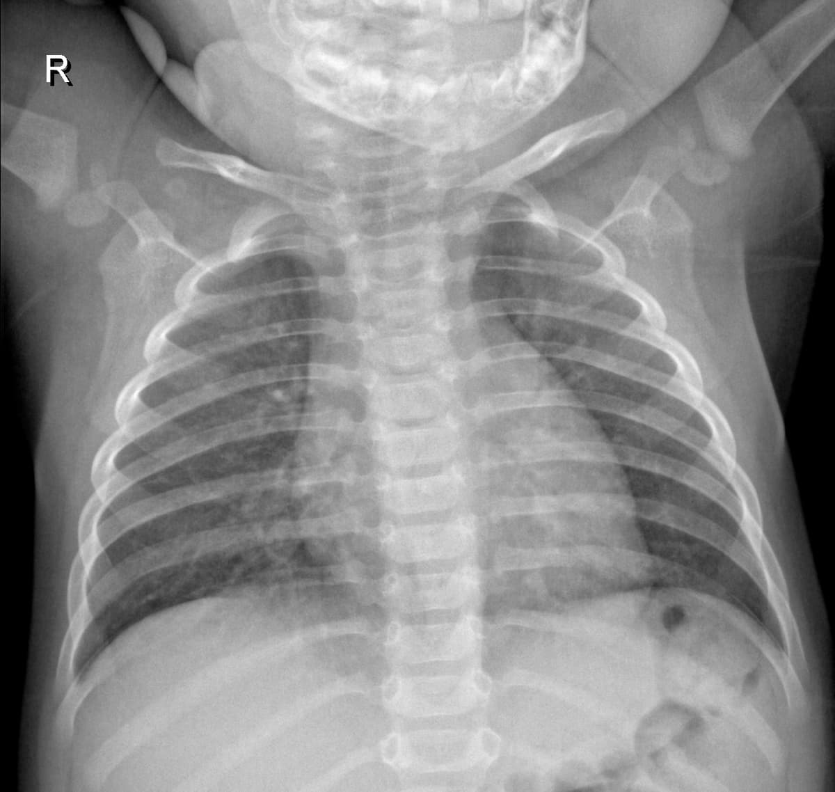 Radiografia Normal — NIH Chest X-ray14