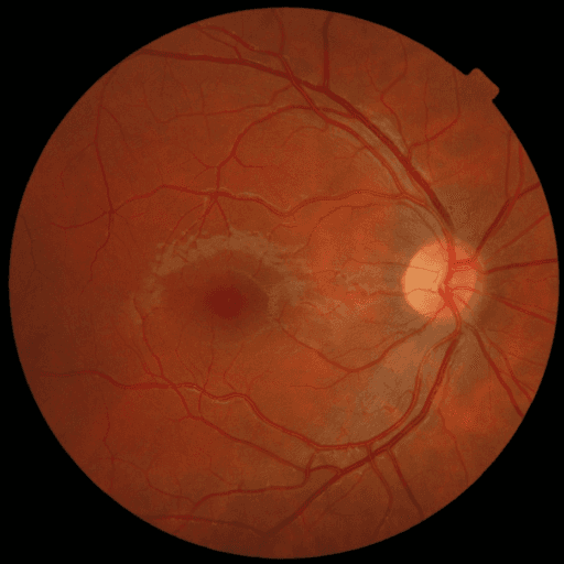 No Diabetic Retinopathy — MESSIDOR-2