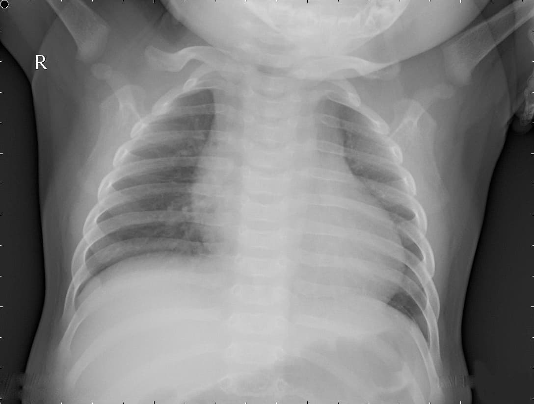 Radiografia Normal — NIH Chest X-ray14