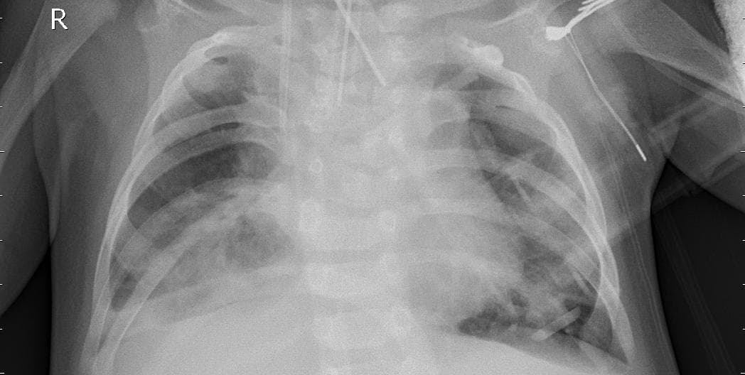 Pneumonia — NIH Chest X-ray14