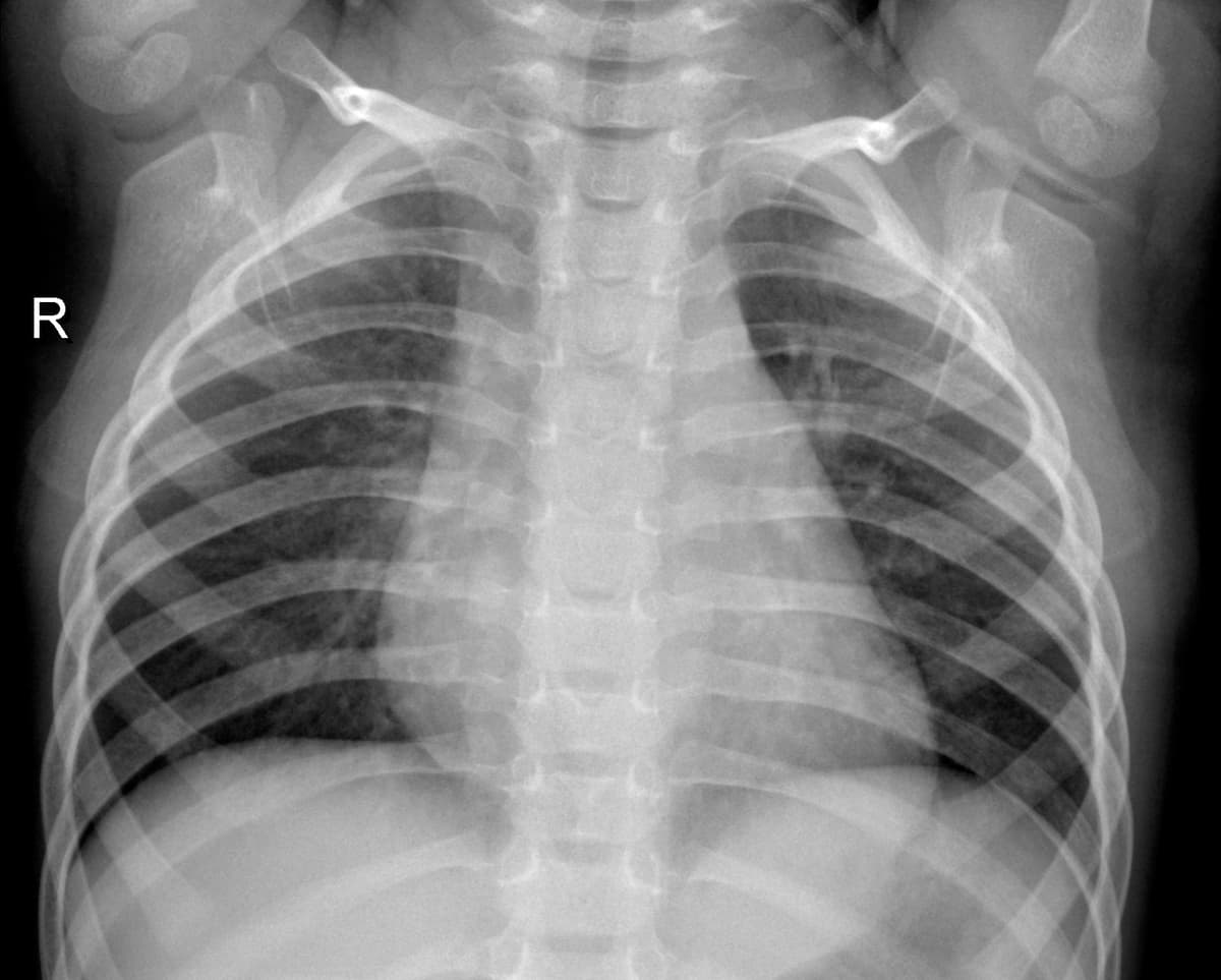Radiografia Normal — NIH Chest X-ray14