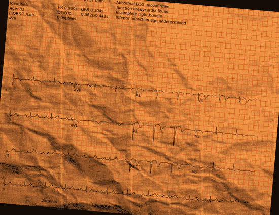 Normal ECG — PTB-XL