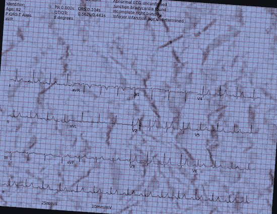 Normal ECG — PTB-XL