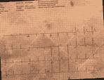 Normal ECG — PTB-XL
