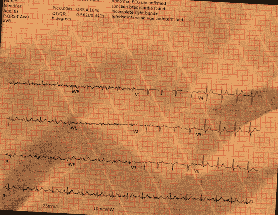 Normal ECG — PTB-XL