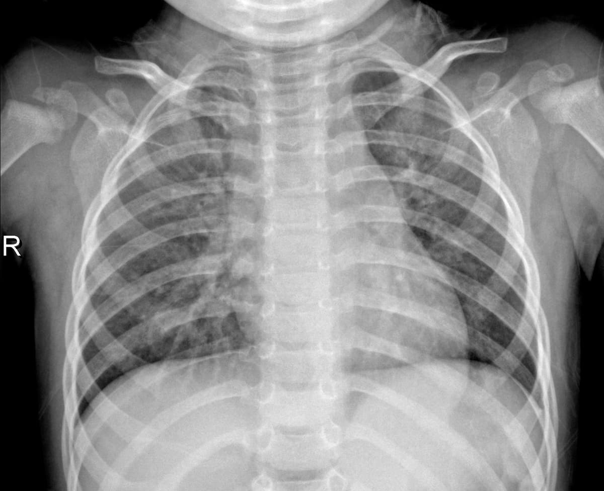 Radiografia Normal — NIH Chest X-ray14