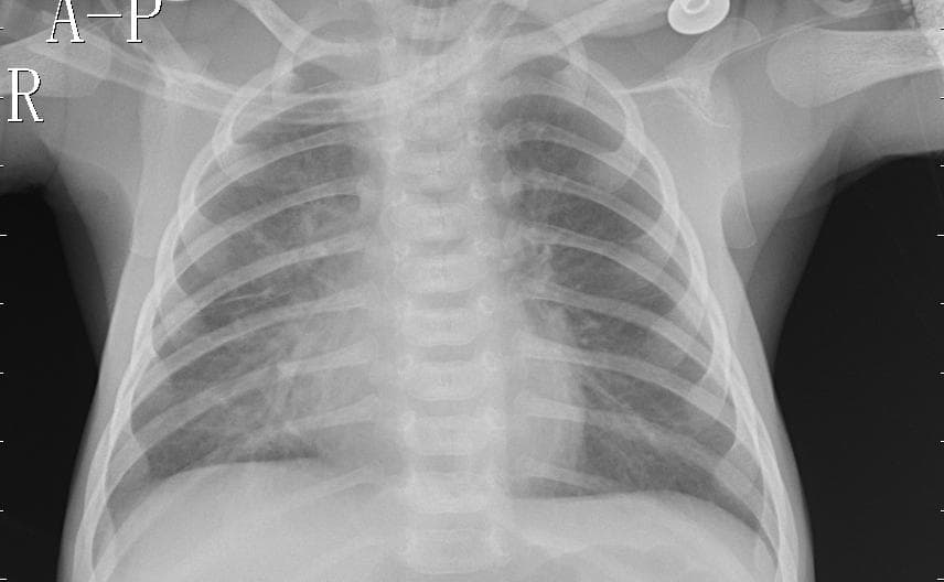 Pneumonia — NIH Chest X-ray14
