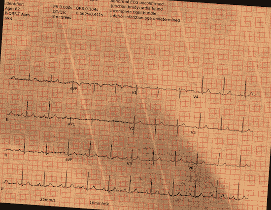Normal ECG — PTB-XL