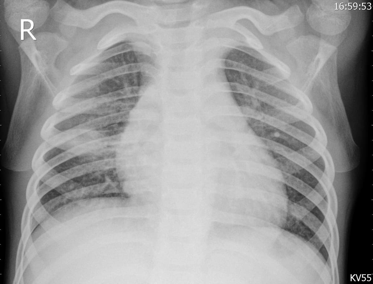Pneumonia — NIH Chest X-ray14