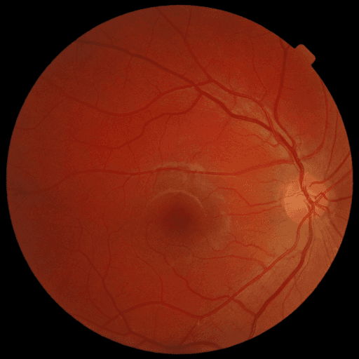 No Diabetic Retinopathy — MESSIDOR-2