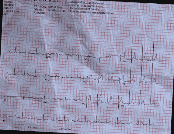 Normal ECG — PTB-XL