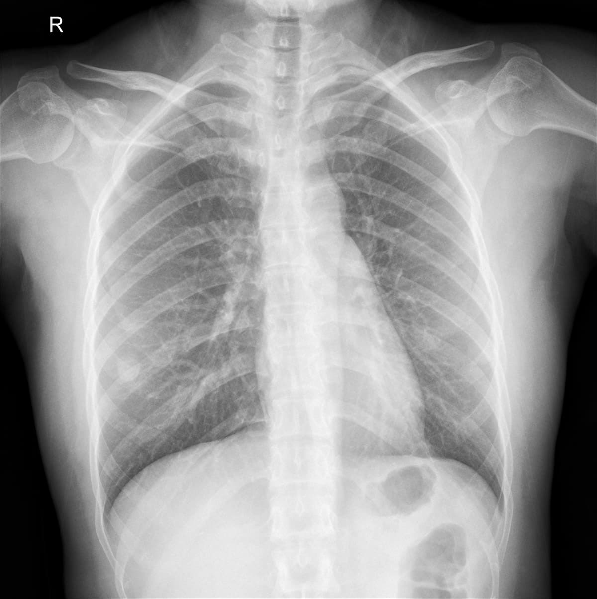Radiografia Normal — NIH Chest X-ray14