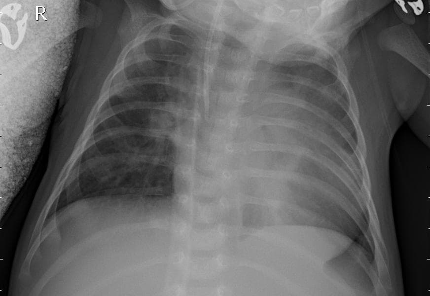 Pneumonia — NIH Chest X-ray14