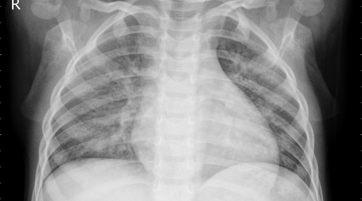 Pneumonia — NIH Chest X-ray14