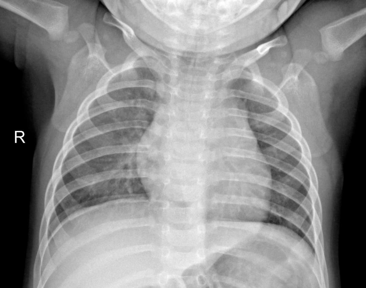 Radiografia Normal — NIH Chest X-ray14