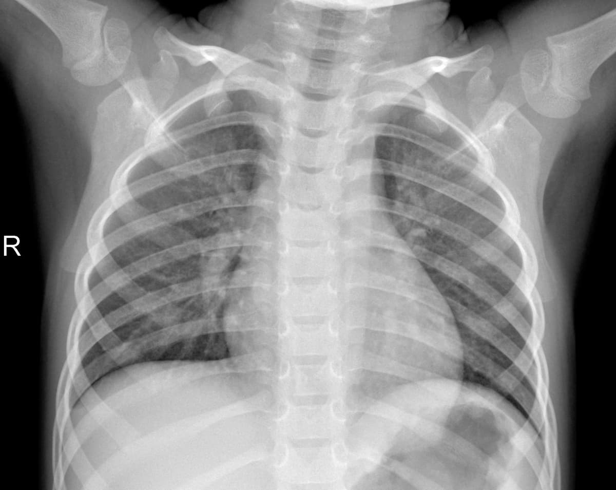 Radiografia Normal — NIH Chest X-ray14