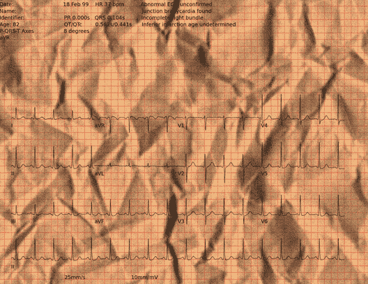 Normal ECG — PTB-XL