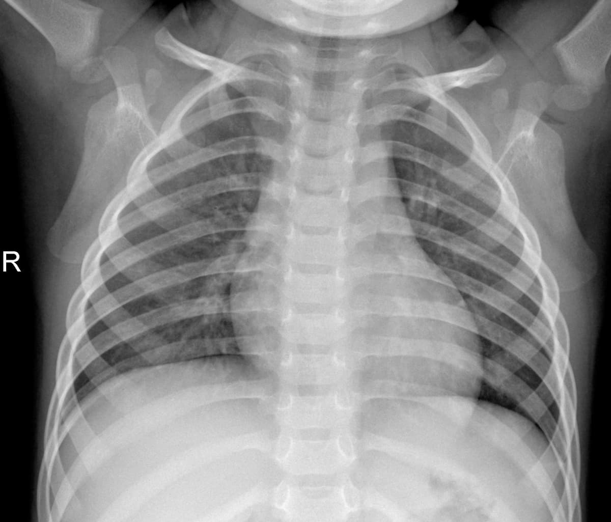 Radiografia Normal — NIH Chest X-ray14