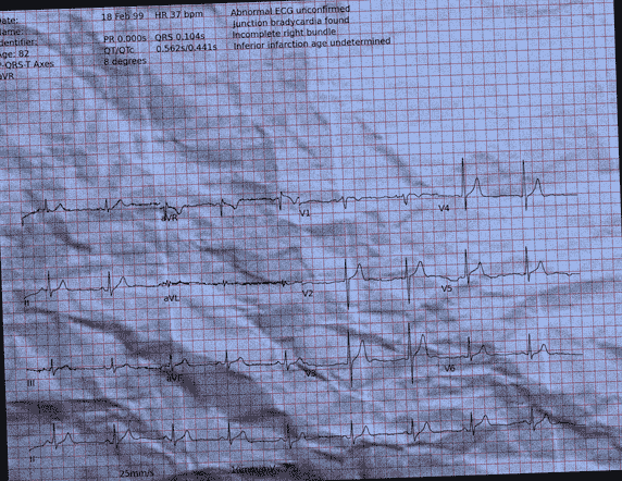 Normal ECG — PTB-XL