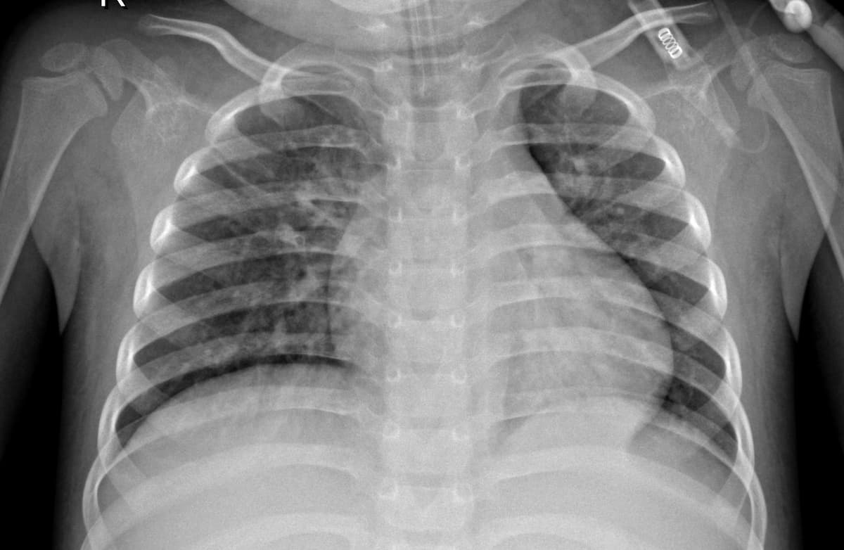Pneumonia — NIH Chest X-ray14