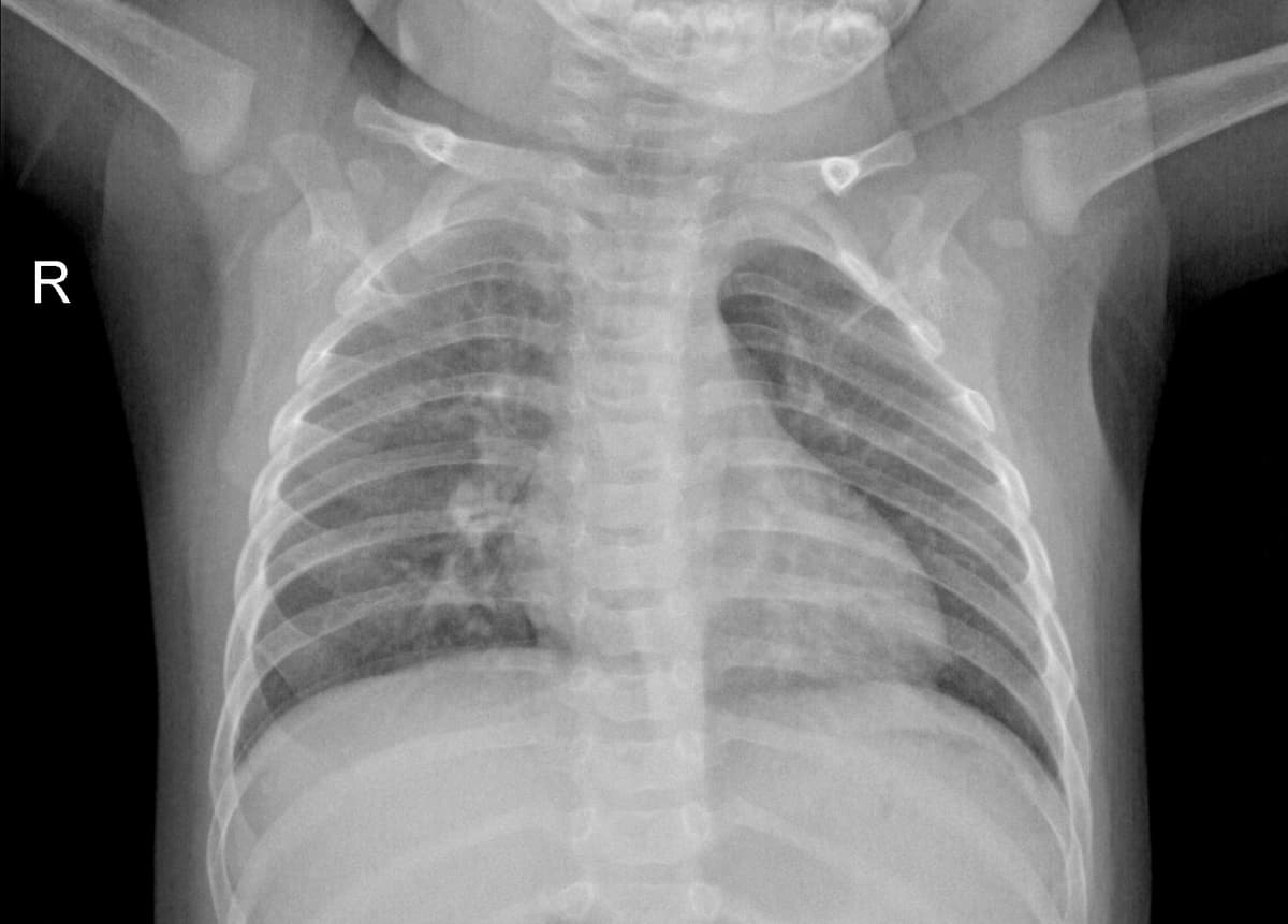 Radiografia Normal — NIH Chest X-ray14