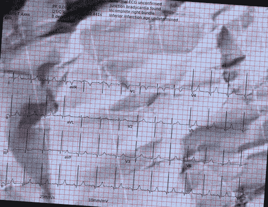 Normal ECG — PTB-XL