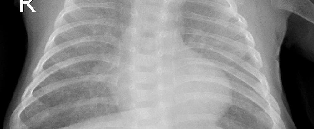 Pneumonia — NIH Chest X-ray14
