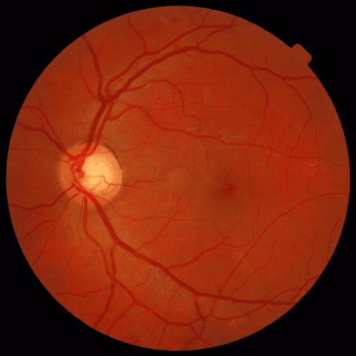 No Diabetic Retinopathy — MESSIDOR-2