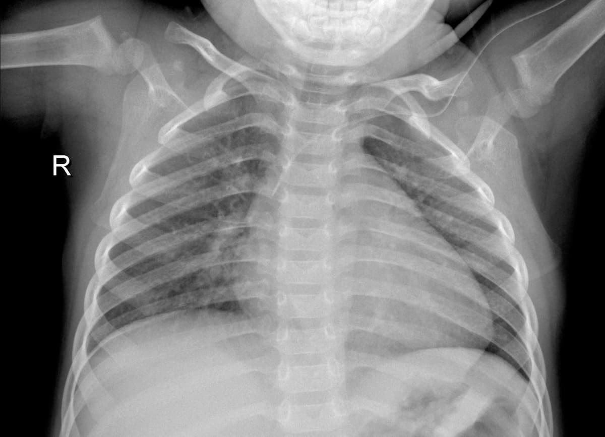 Radiografia Normal — NIH Chest X-ray14