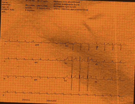 Normal ECG — PTB-XL