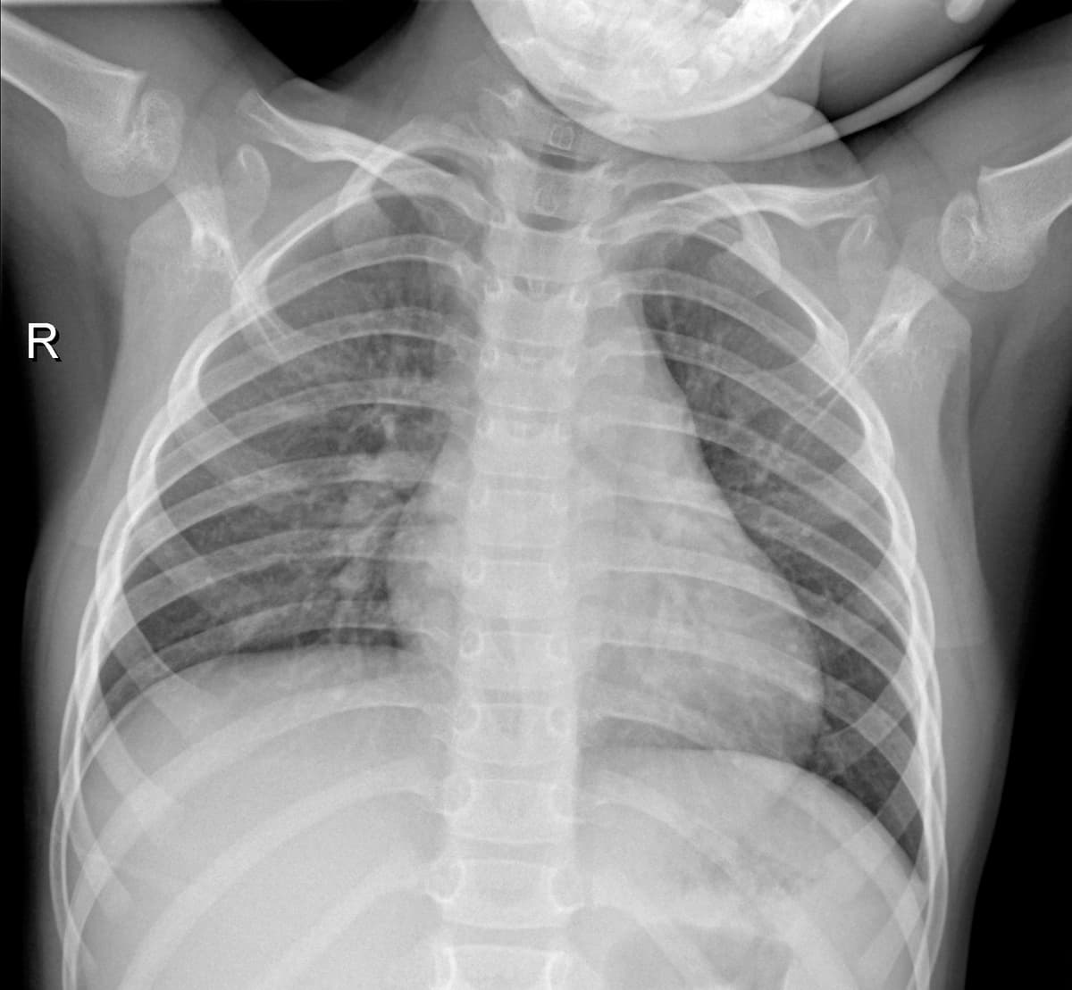 Radiografia Normal — NIH Chest X-ray14