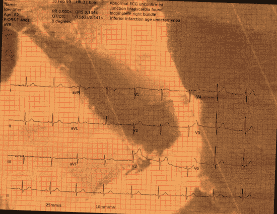 Normal ECG — PTB-XL