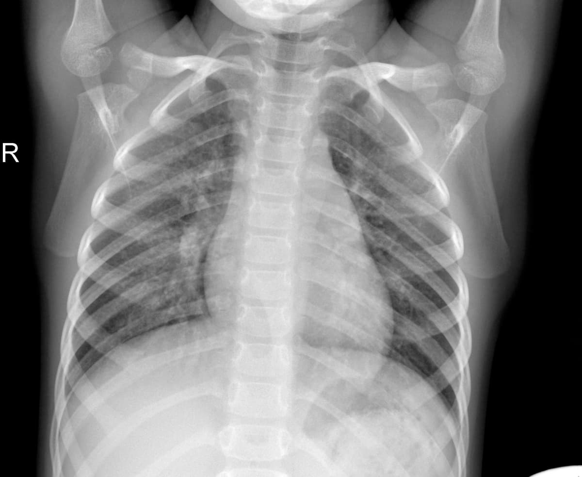 Radiografia Normal — NIH Chest X-ray14