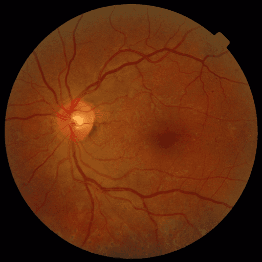 No Diabetic Retinopathy — MESSIDOR-2