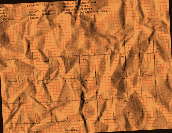 Normal ECG — PTB-XL