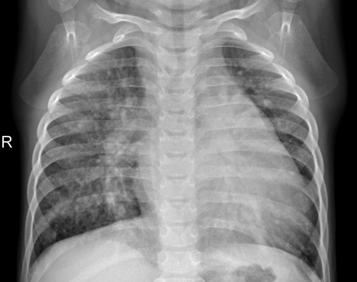 Pneumonia — NIH Chest X-ray14