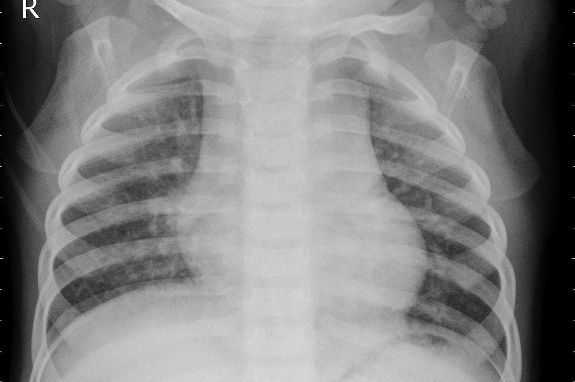 Pneumonia — NIH Chest X-ray14