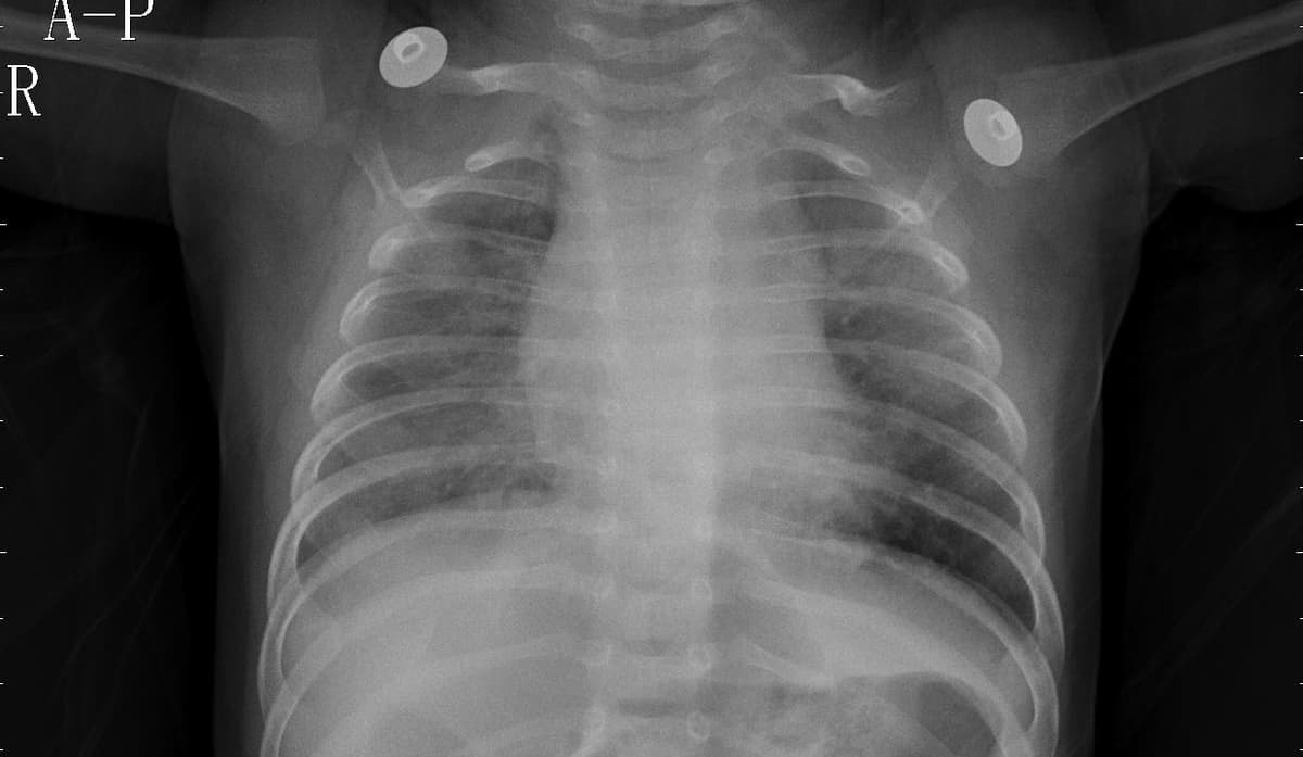 Pneumonia — NIH Chest X-ray14