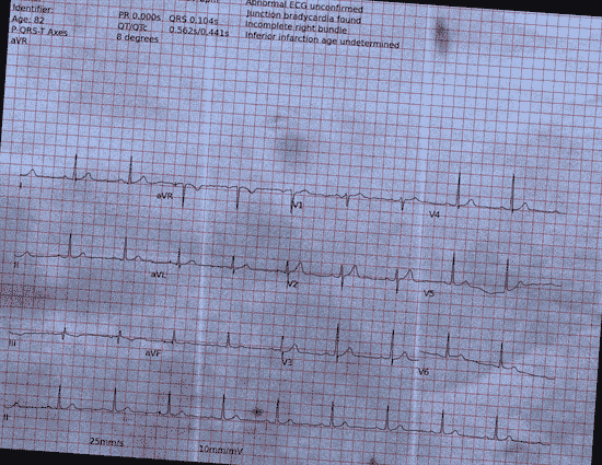 Normal ECG — PTB-XL