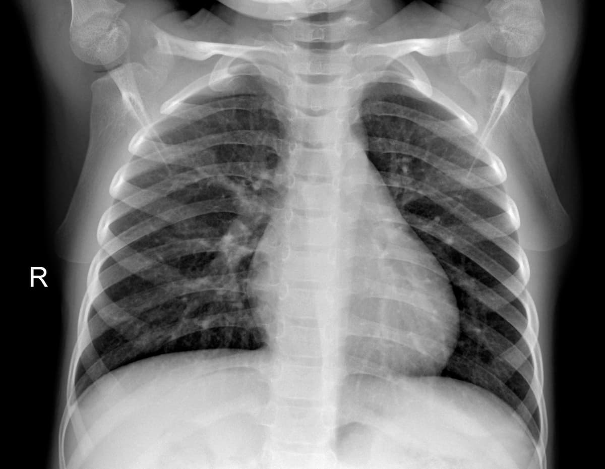 Radiografia Normal — NIH Chest X-ray14