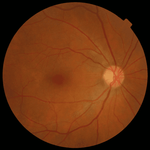 No Diabetic Retinopathy — MESSIDOR-2