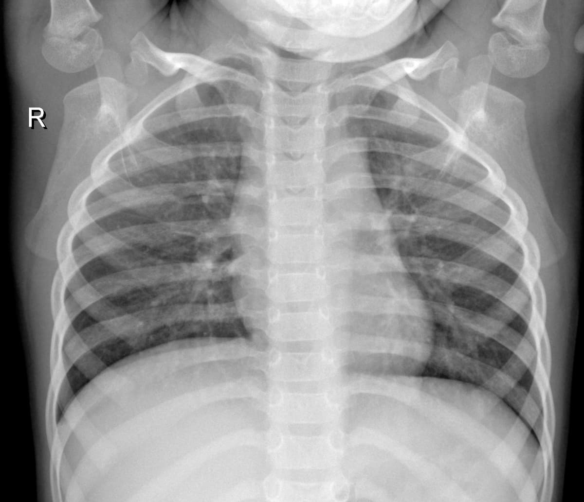Radiografia Normal — NIH Chest X-ray14