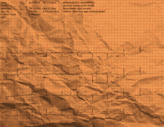 Normal ECG — PTB-XL