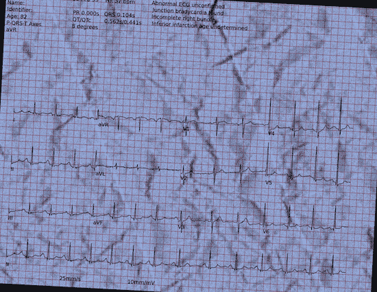 Normal ECG — PTB-XL