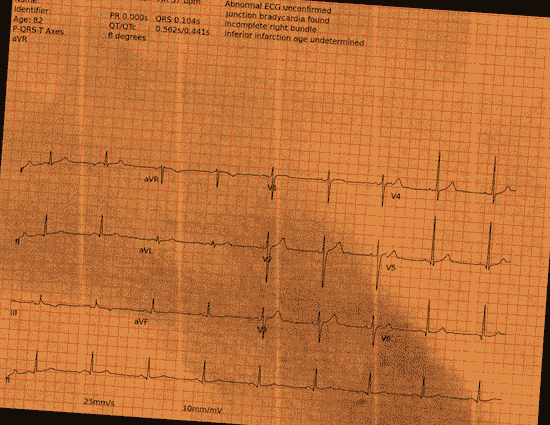 Normal ECG — PTB-XL
