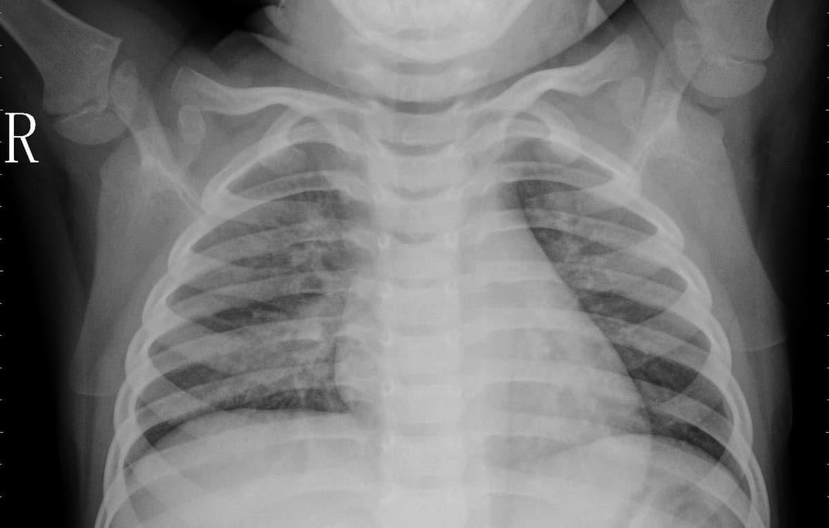 Pneumonia — NIH Chest X-ray14