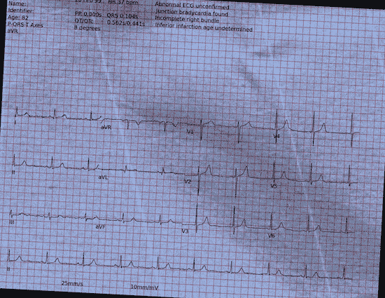 Normal ECG — PTB-XL