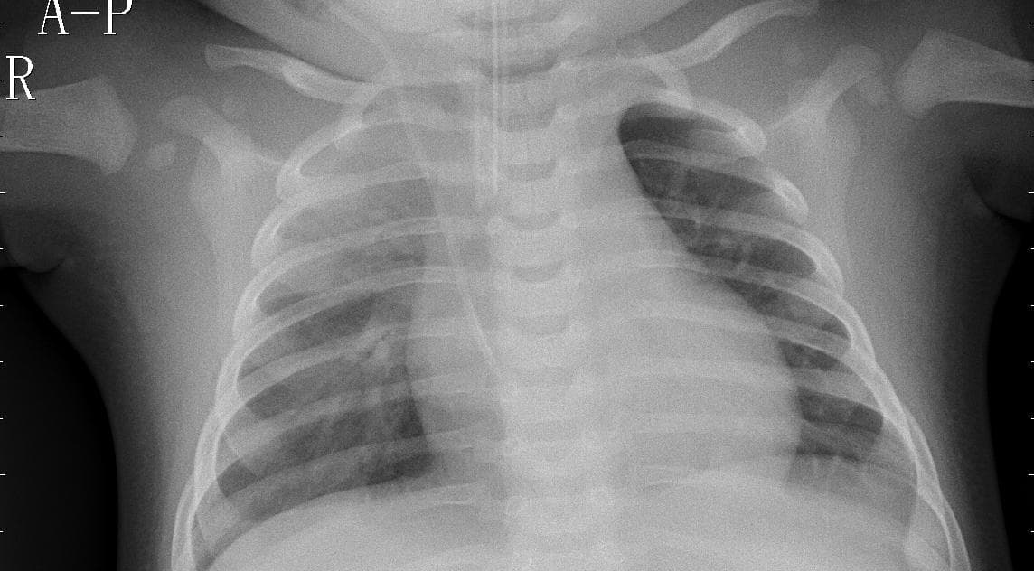 Pneumonia — NIH Chest X-ray14