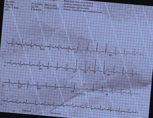 Normal ECG — PTB-XL
