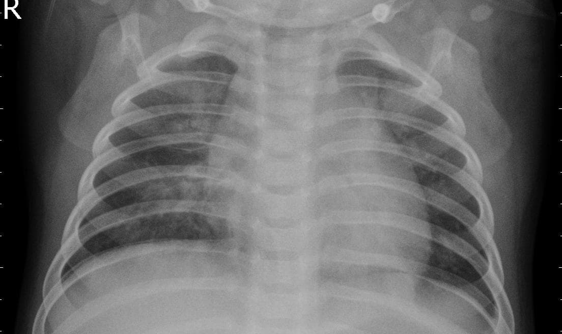 Pneumonia — NIH Chest X-ray14